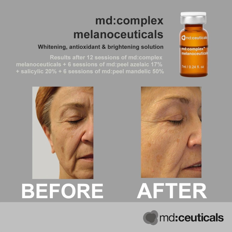 Md:ceuticals Complex Melanoceuticals _ Tinh chất meso trị nám tàn nhang và dưỡng trắng da