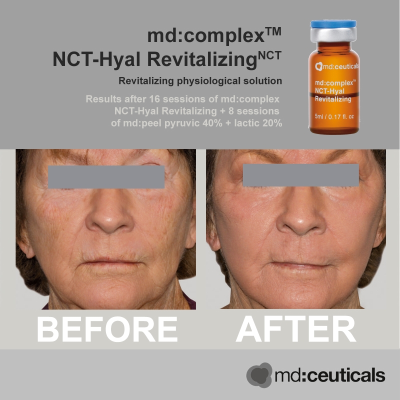 Md:ceuticals Md Complex NCT-Hyal Revitalizing _ Tinh chất meso căng bóng và phục hồi trẻ hóa làn da toàn diện